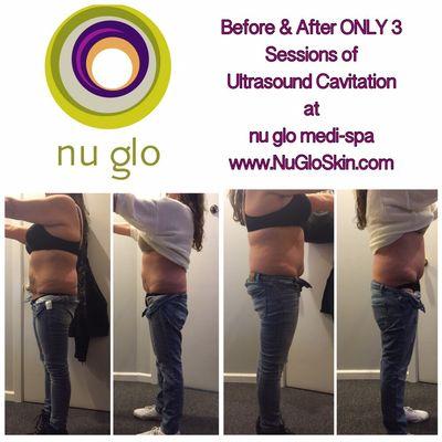 Before and After ONLY 3 sessions of Cavi-Lipo (ultrasound cavitation) with RF skin tightening by Rona at nu glo!