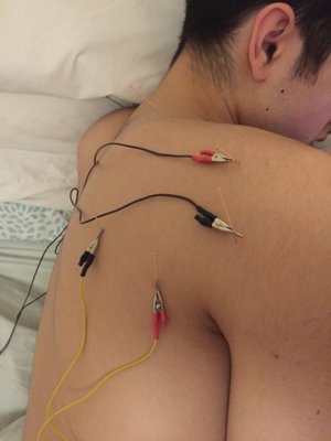 Electro Acupuncture treatment of posterior shoulder pain.