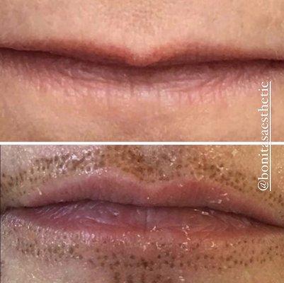 Subtle lip lift with fibroblast