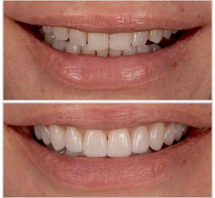 Full smile makeover. What is your ideal smile?