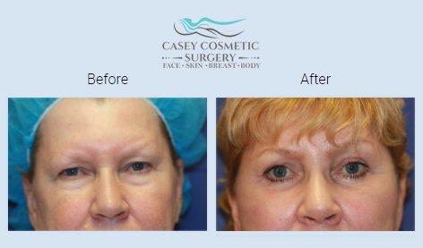 Perk Up Your Peepers With Blepharoplasty!