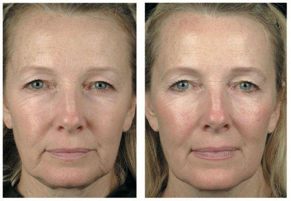 Thermage skin tightening treatment