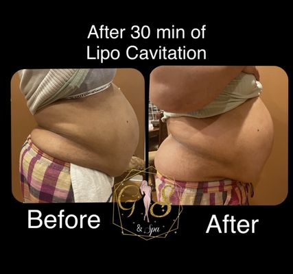 Lipo Cavitation