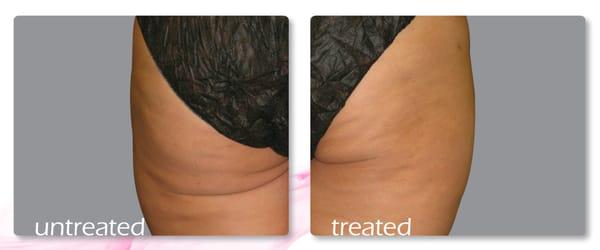 before and after 8 Cellulite Treatments with Reaction