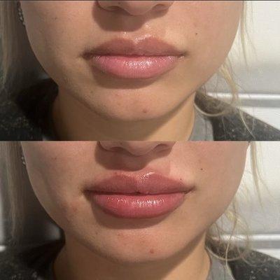 Versa Lip Filler

#AbileneTotalWellness