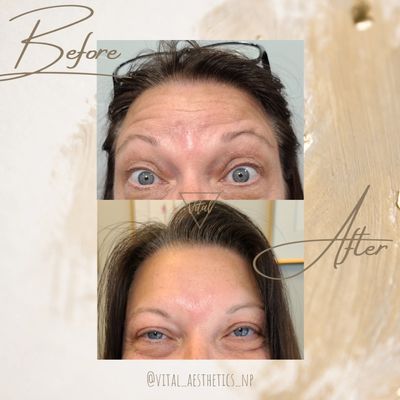 Before and after Botox treatment to relax forehead and frown lines (11s)