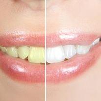 Teeth whitening