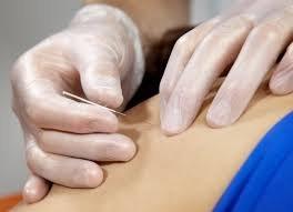 Dry Needling