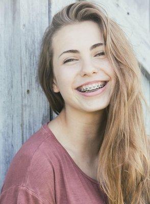 Traditional metal braces are the most common type of braces and are smaller and more comfortable than previous models.