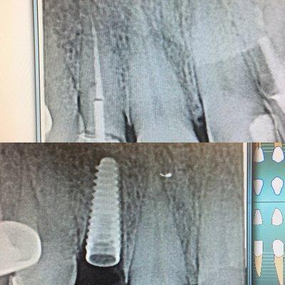 Immediate implant placement after extraction