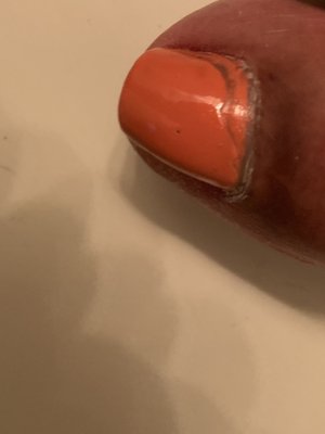 Nail cracking from both toes