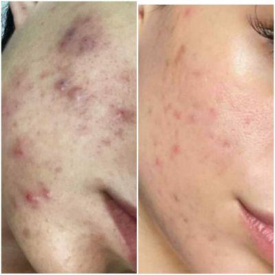 amazing results after 1 Hydro Luxx treament with extractions