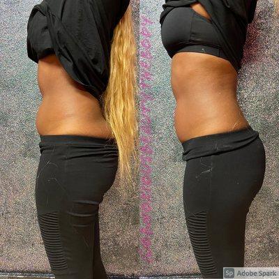 Before And After One 360 Cavitation