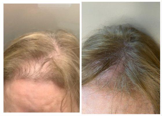 PRP hair restoration