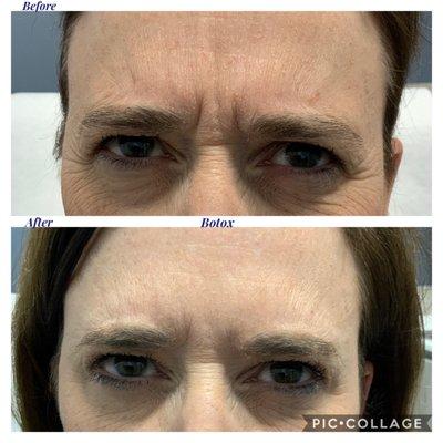 Botox treatment, between the eyebrows; notice the dramatic improvement in dynamic lines