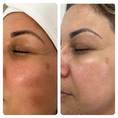 Sculpting Treatments