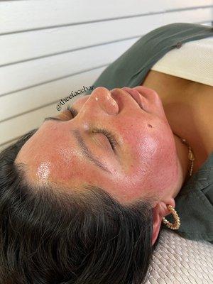 The aftermath of microneedling. This client is hoping to minimize her pores, reduce her acne scarring and look refreshed.