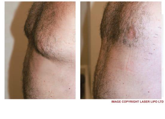 Male Chest reduced after eight lipo laser treatments.  Dramatic, safe, lasting, painless, non-invasive