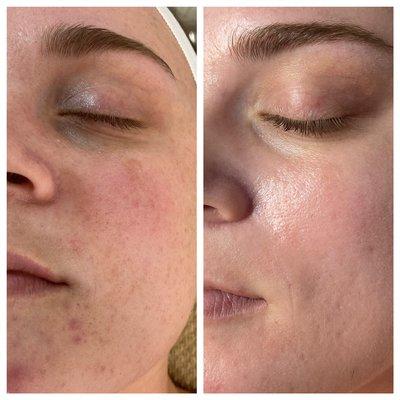 Before and after of Clear Skin Program.