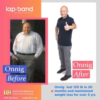 Lap Band Surgery Before and After Onnig