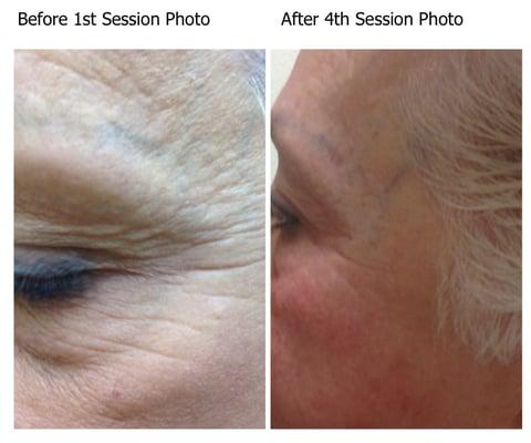 Results of Actual Patient Using Wrinkle Removal-Radio frequency Treatments