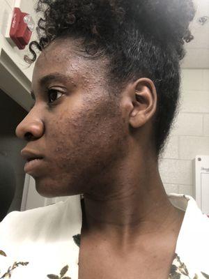 BEFORE picture: non inflamed acne and hyperpigmentation