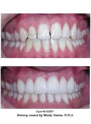 Before & After photo Veneers