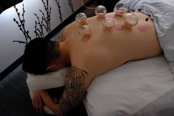 Cupping is often used in sports settings for tight muscles.