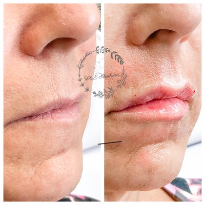 Dermal Filler Lip Enhancement Juvaderm Ultra Plus