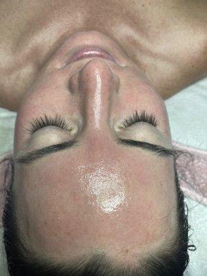 Beautiful skin after a hydrafacial