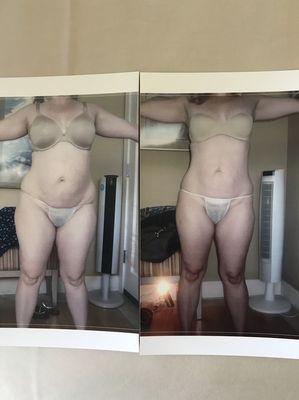 Before and after no lipo lipo