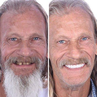 Final result of full mouth dental implants!