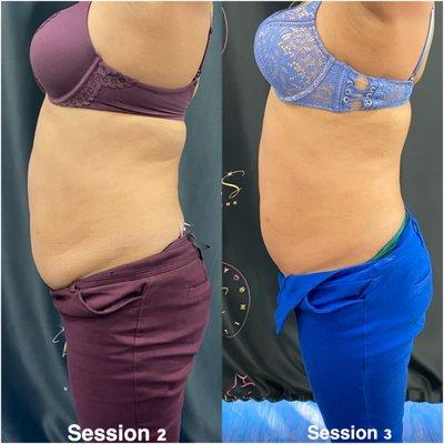 Ultrasound cavitation non-invasive gets rid of stubborn fat.