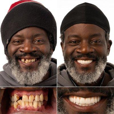 Beautiful before/after with Full Mouth Implants