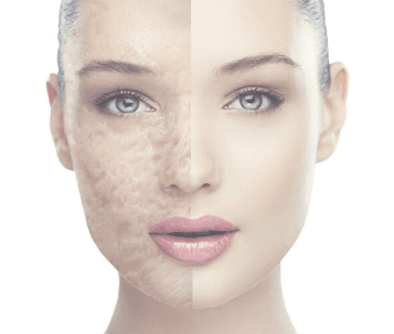 Acne scars? We can help. Skin Pen microneedling with PRP.