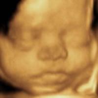 3D ultrasound at 34 weeks