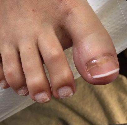 TOENAIL RECONSTRUCTION         After reconstruction