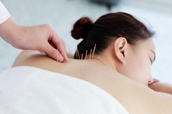 The Medical acupuncture!