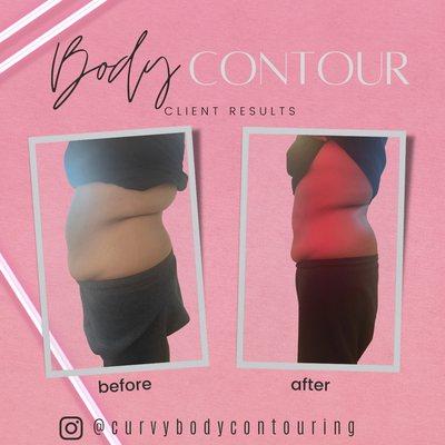 Curvy Body Contouring