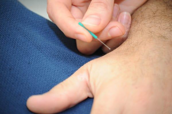 An acupuncture needle