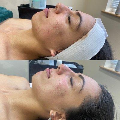 Before and after of the Glowing Beach Facial