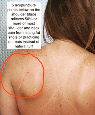 Acupuncture strategy for neck and shoulder pain relief