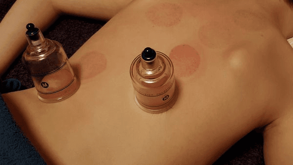 Cupping Therapy