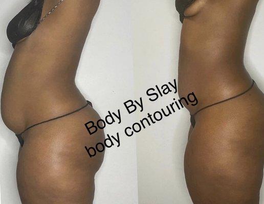 Body contouring