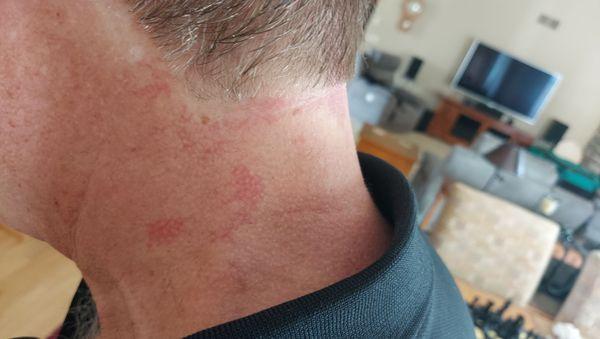 Painful red marks left by the "barber".