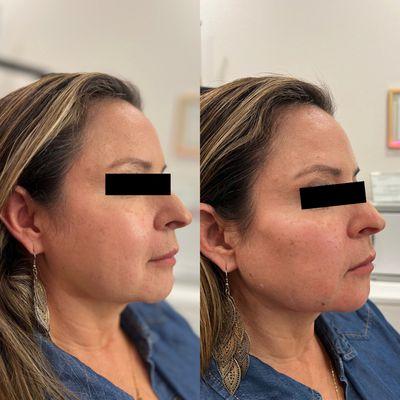 Cheek + Jawline filler with Radiesse