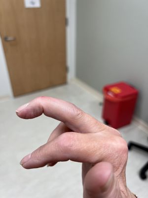 Mallet finger.