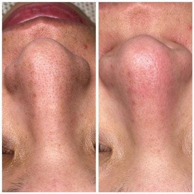 Black head deep pore cleanse - before & after