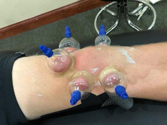 Cupping/Taping