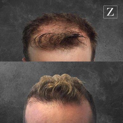 Male Hair Rejuvenation - FUE FUT